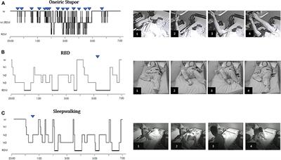 Differentiating Oneiric Stupor in Agrypnia Excitata From Dreaming Disorders